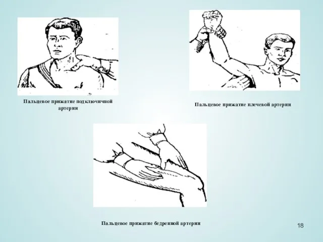 Пальцевое прижатие подключичной артерии Пальцевое прижатие плечевой артерии Пальцевое прижатие бедренной артерии