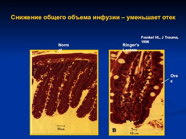 Снижение общего объема инфузии – уменьшает отек Frankel HL, J Trauma, 1996 Normal Ringer’s Lactate Отек