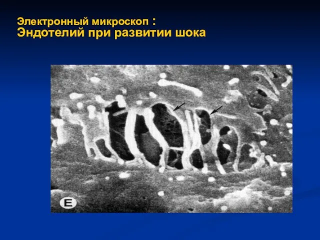 Электронный микроскоп : Эндотелий при развитии шока