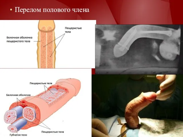 Перелом полового члена