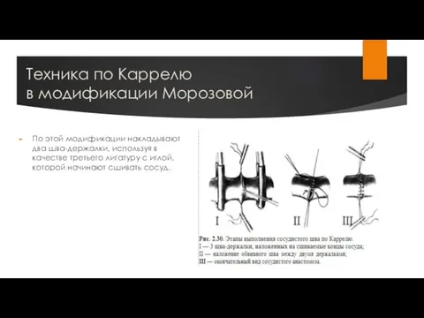 Техника по Каррелю в модификации Морозовой По этой модификации накладывают два шва-держалки,