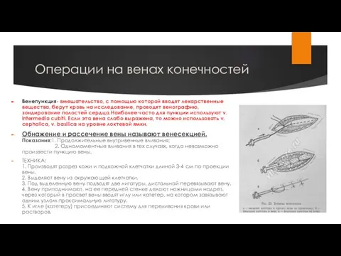 Операции на венах конечностей Венепункция- вмешательство, с помощью которой вводят лекарственные вещества,