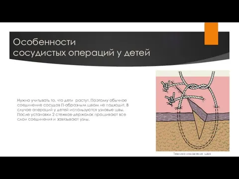 Особенности сосудистых операций у детей Нужно учитывать то, что дети растут. Поэтому