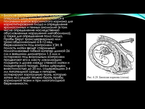 Биопсия (аспирация) ворсин хориона - операция, цель которой заключается в получении клеток