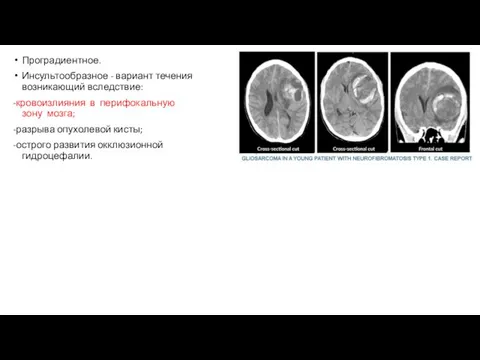 Проградиентное. Инсультообразное - вариант течения возникающий вследствие: -кровоизлияния в перифокальную зону мозга;