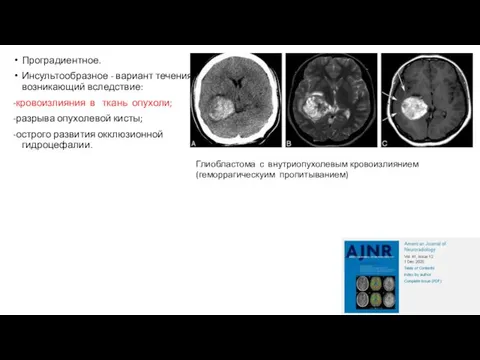 Проградиентное. Инсультообразное - вариант течения возникающий вследствие: -кровоизлияния в ткань опухоли; -разрыва