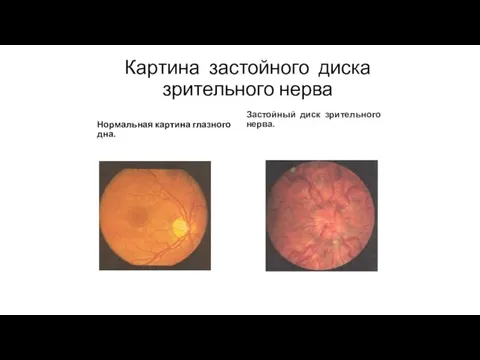 Картина застойного диска зрительного нерва Нормальная картина глазного дна. Застойный диск зрительного нерва.