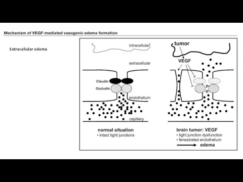 Extracellular edema