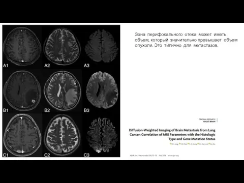 Зона перифокального отека может иметь объем, который значительно превышает объем опухоли. Это типично для метастазов.