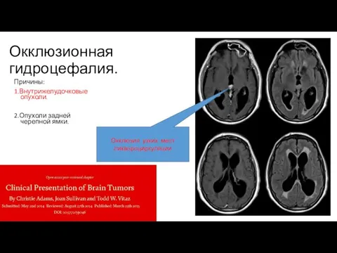 Окклюзионная гидроцефалия. Причины: 1.Внутрижелудочковые опухоли. 2.Опухоли задней черепной ямки. Окклюзия узких мест ликвороциркуляции