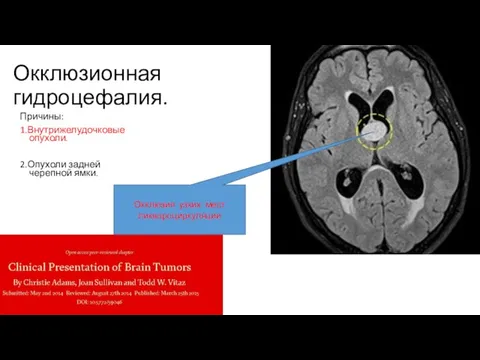 Окклюзионная гидроцефалия. Причины: 1.Внутрижелудочковые опухоли. 2.Опухоли задней черепной ямки. Окклюзия узких мест ликвороциркуляции