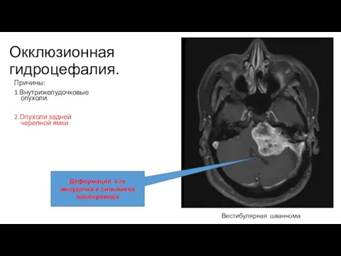Окклюзионная гидроцефалия. Причины: 1.Внутрижелудочковые опухоли. 2.Опухоли задней черепной ямки. Деформация 4-го желудочка