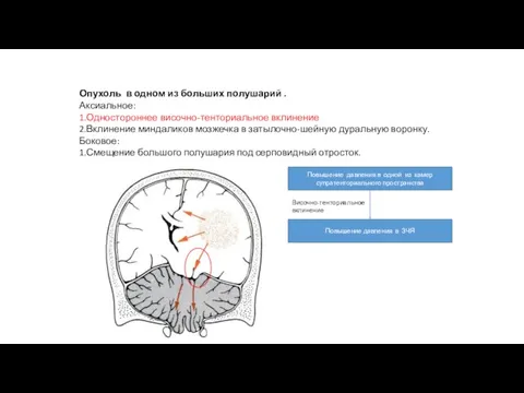 Опухоль в одном из больших полушарий . Аксиальное: 1.Одностороннее височно-тенториальное вклинение 2.Вклинение