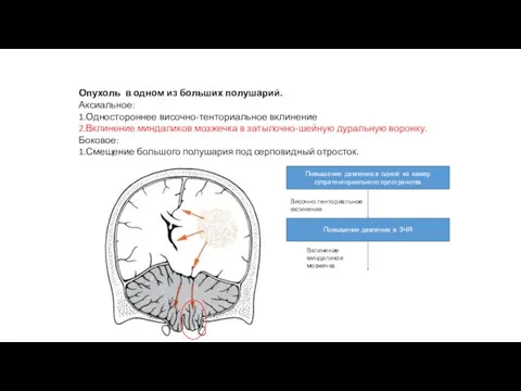 Опухоль в одном из больших полушарий. Аксиальное: 1.Одностороннее височно-тенториальное вклинение 2.Вклинение миндаликов