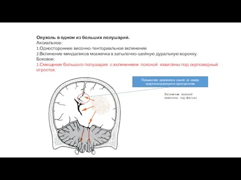 Опухоль в одном из больших полушарий. Аксиальное: 1.Одностороннее височно-тенториальное вклинение 2.Вклинение миндаликов