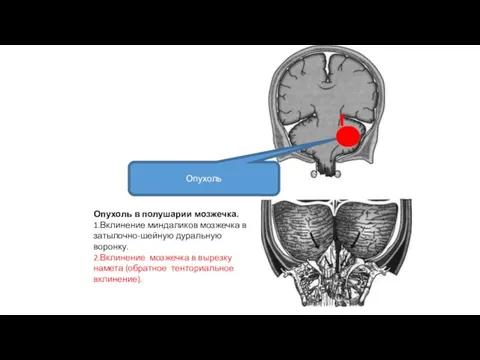 Опухоль в полушарии мозжечка. 1.Вклинение миндаликов мозжечка в затылочно-шейную дуральную воронку. 2.Вклинение