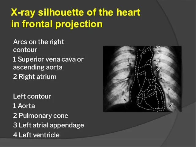 X-ray silhouette of the heart in frontal projection Arcs on the right