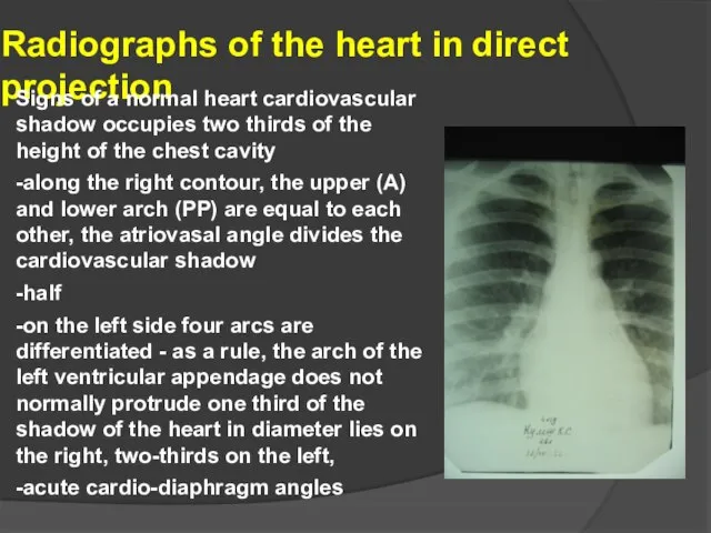 Radiographs of the heart in direct projection Signs of a normal heart