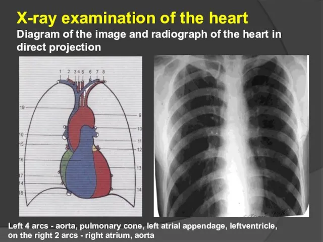 X-ray examination of the heart Diagram of the image and radiograph of