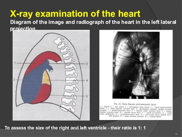 16 X-ray examination of the heart Diagram of the image and radiograph