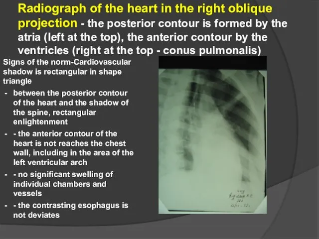 Radiograph of the heart in the right oblique projection - the posterior