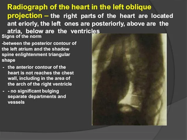 Radiograph of the heart in the left oblique projection – the right