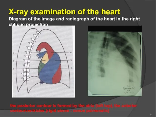 19 X-ray examination of the heart Diagram of the image and radiograph