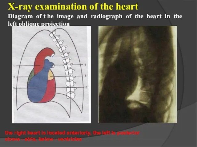 X-ray examination of the heart Diagram of t he image and radiograph