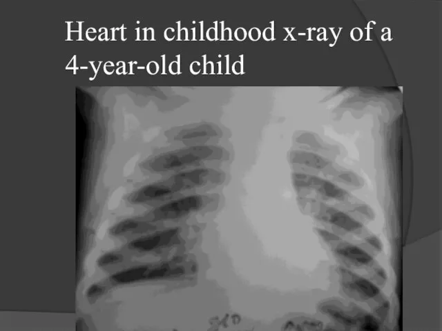 Heart in childhood x-ray of a 4-year-old child