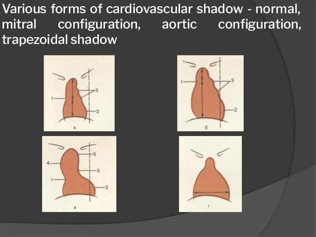 Various forms of cardiovascular shadow - normal, mitral configuration, aortic configuration, trapezoidal shadow