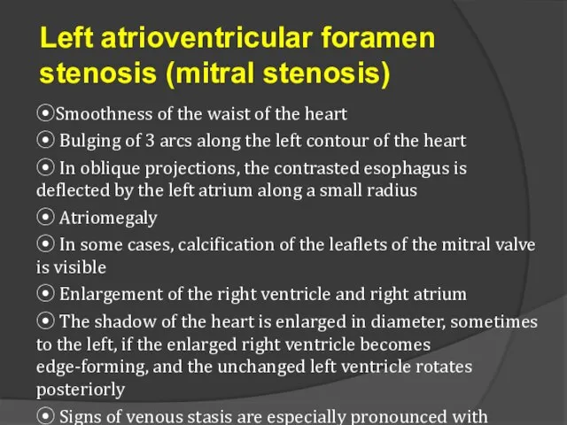 Left atrioventricular foramen stenosis (mitral stenosis) ⦿Smoothness of the waist of the