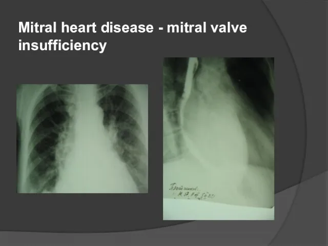 Mitral heart disease - mitral valve insufficiency