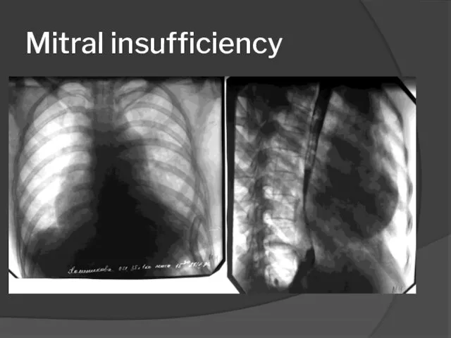 Mitral insufficiency