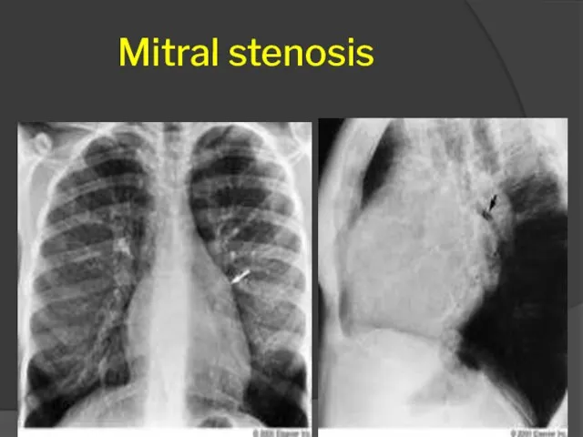 Mitral stenosis 32