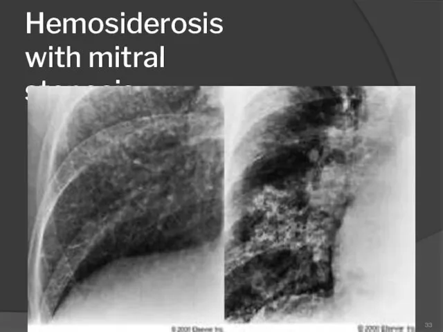 Hemosiderosis with mitral stenosis 33