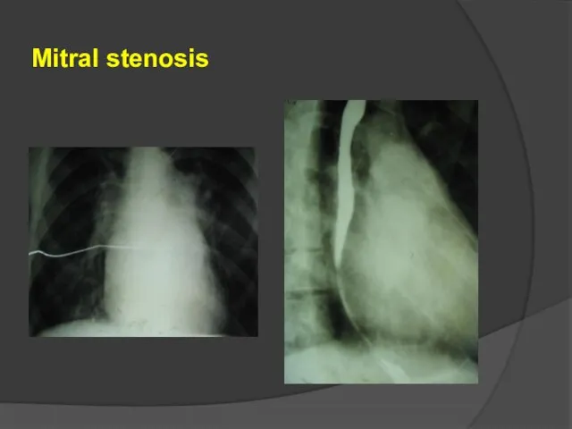 Mitral stenosis