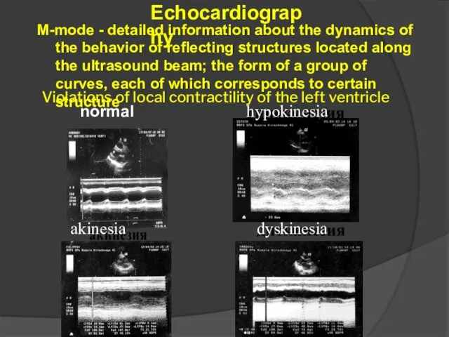 Echocardiography M-mode - detailed information about the dynamics of the behavior of