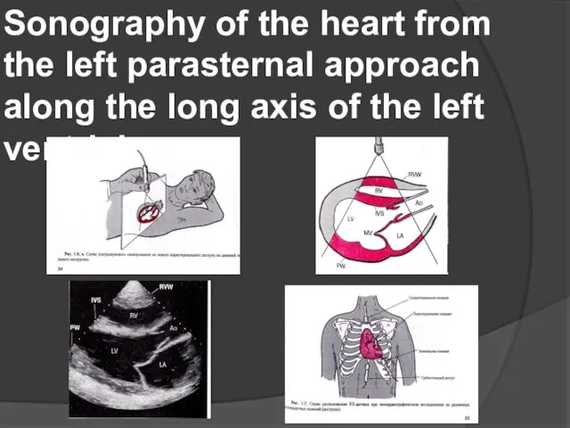 Sonography of the heart from the left parasternal approach along the long