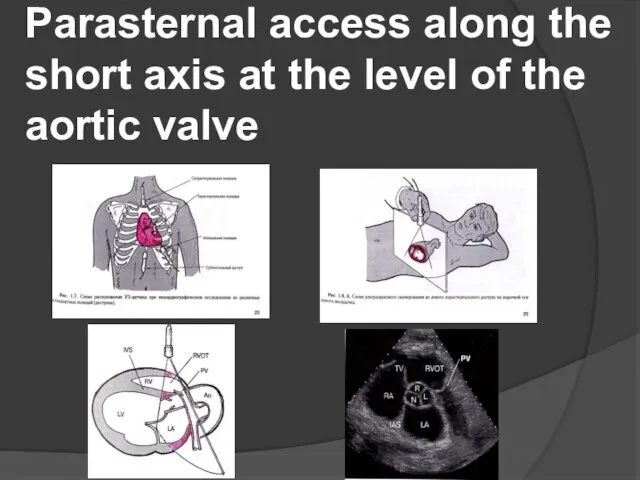 Parasternal access along the short axis at the level of the aortic valve