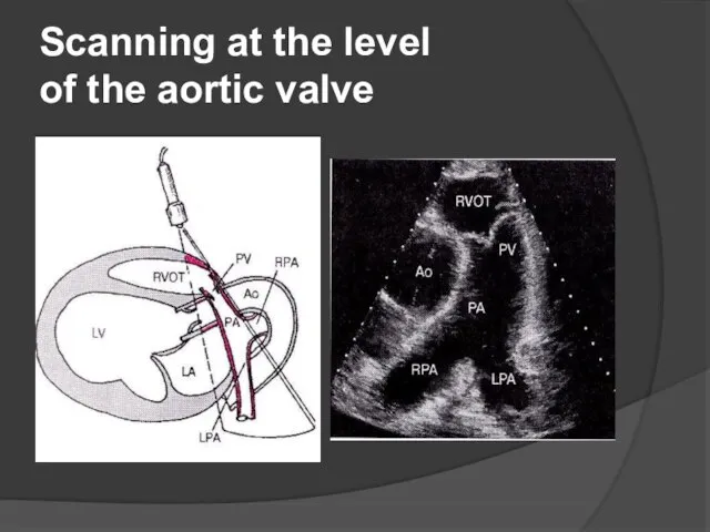 Scanning at the level of the aortic valve