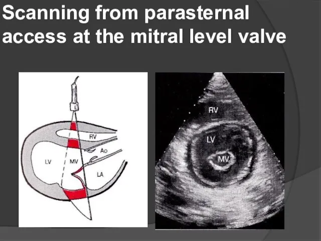 Scanning from parasternal access at the mitral level valve