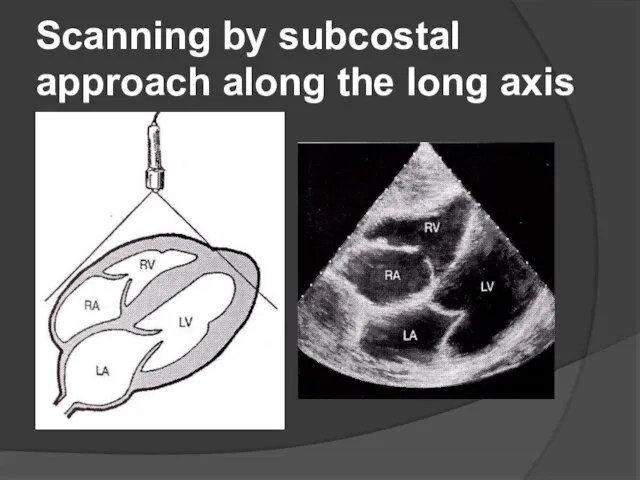 Scanning by subcostal approach along the long axis of the heart