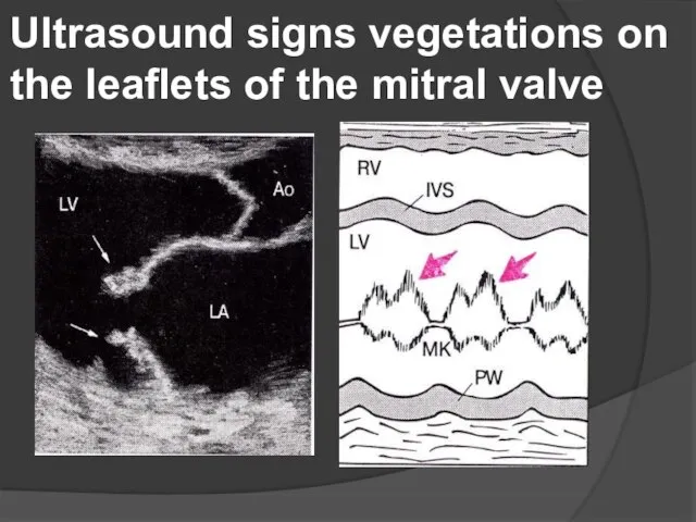 Ultrasound signs vegetations on the leaflets of the mitral valve