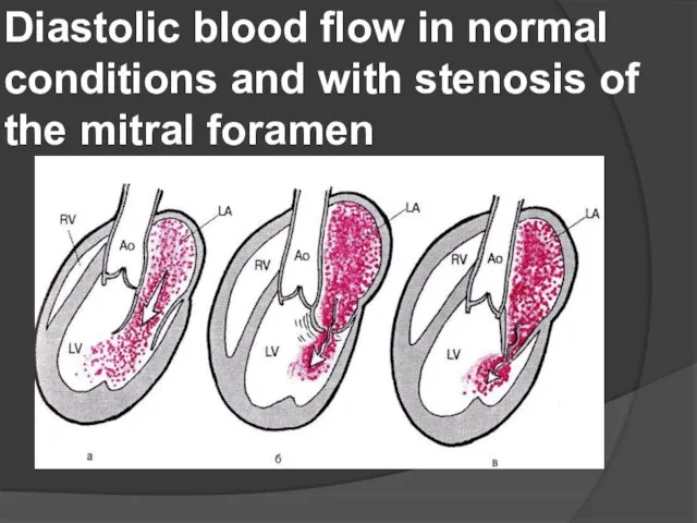 Diastolic blood flow in normal conditions and with stenosis of the mitral foramen