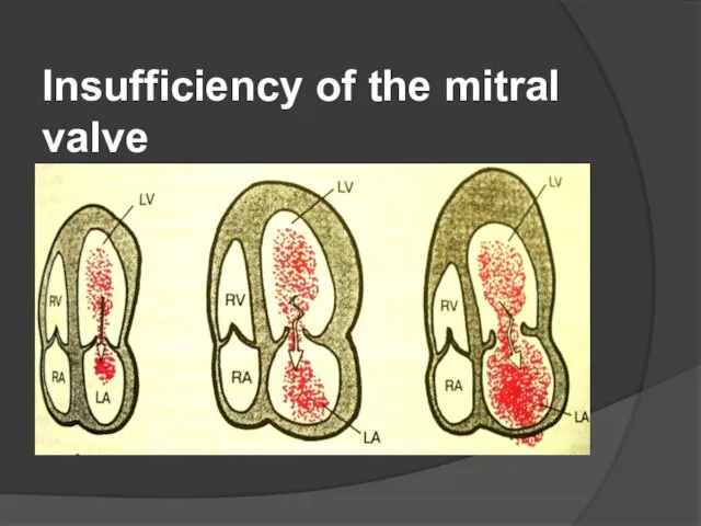 Insufficiency of the mitral valve