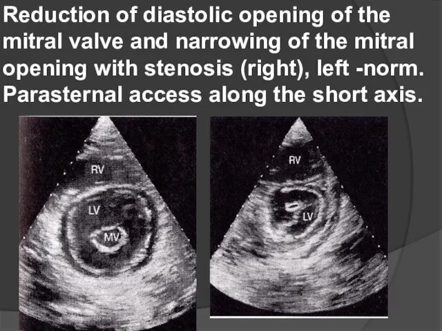 Reduction of diastolic opening of the mitral valve and narrowing of the