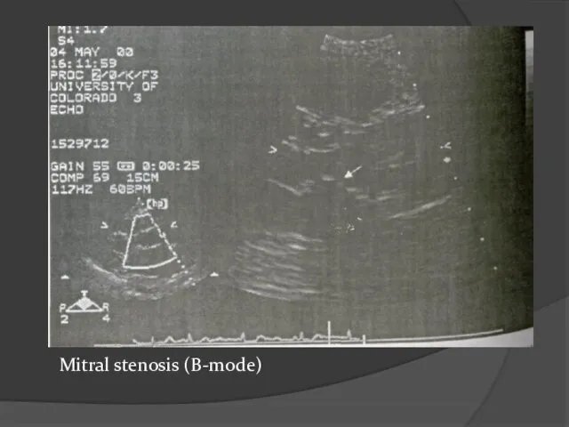 Mitral stenosis (B-mode)