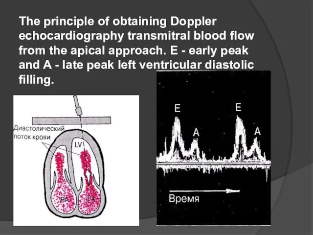 The principle of obtaining Doppler echocardiography transmitral blood flow from the apical