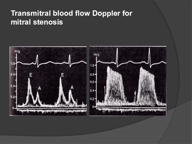 Transmitral blood flow Doppler for mitral stenosis