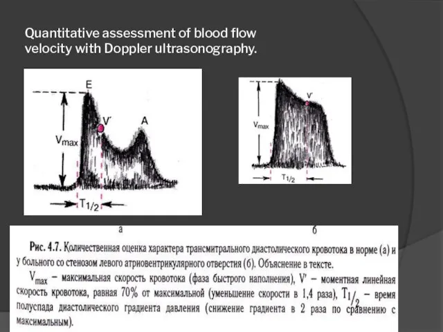 Quantitative assessment of blood flow velocity with Doppler ultrasonography.